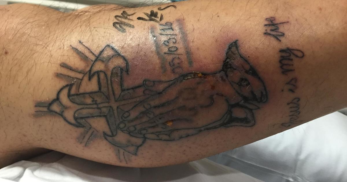 Man dies after flesh-eating bacteria infects new tattoo - CBS News